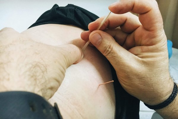 דיקור לטיפול בכאבי גב תחתון דיקור לטיפול בכאבי גב תחתון